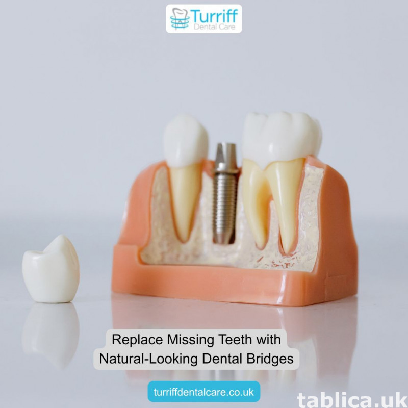 Replace Missing Teeth with Natural-Looking Dental Bridges 0